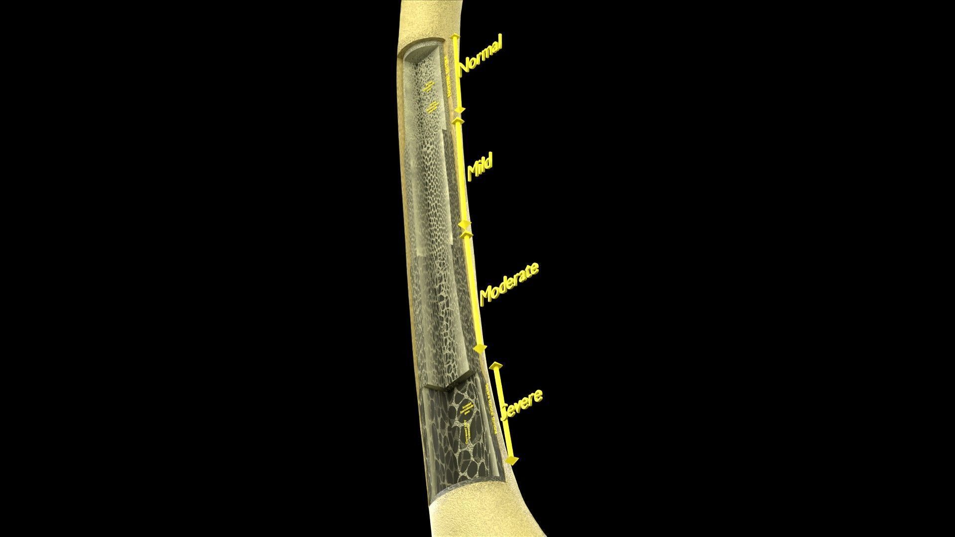 Osteoporosis and its stages Low-poly 3D model_19