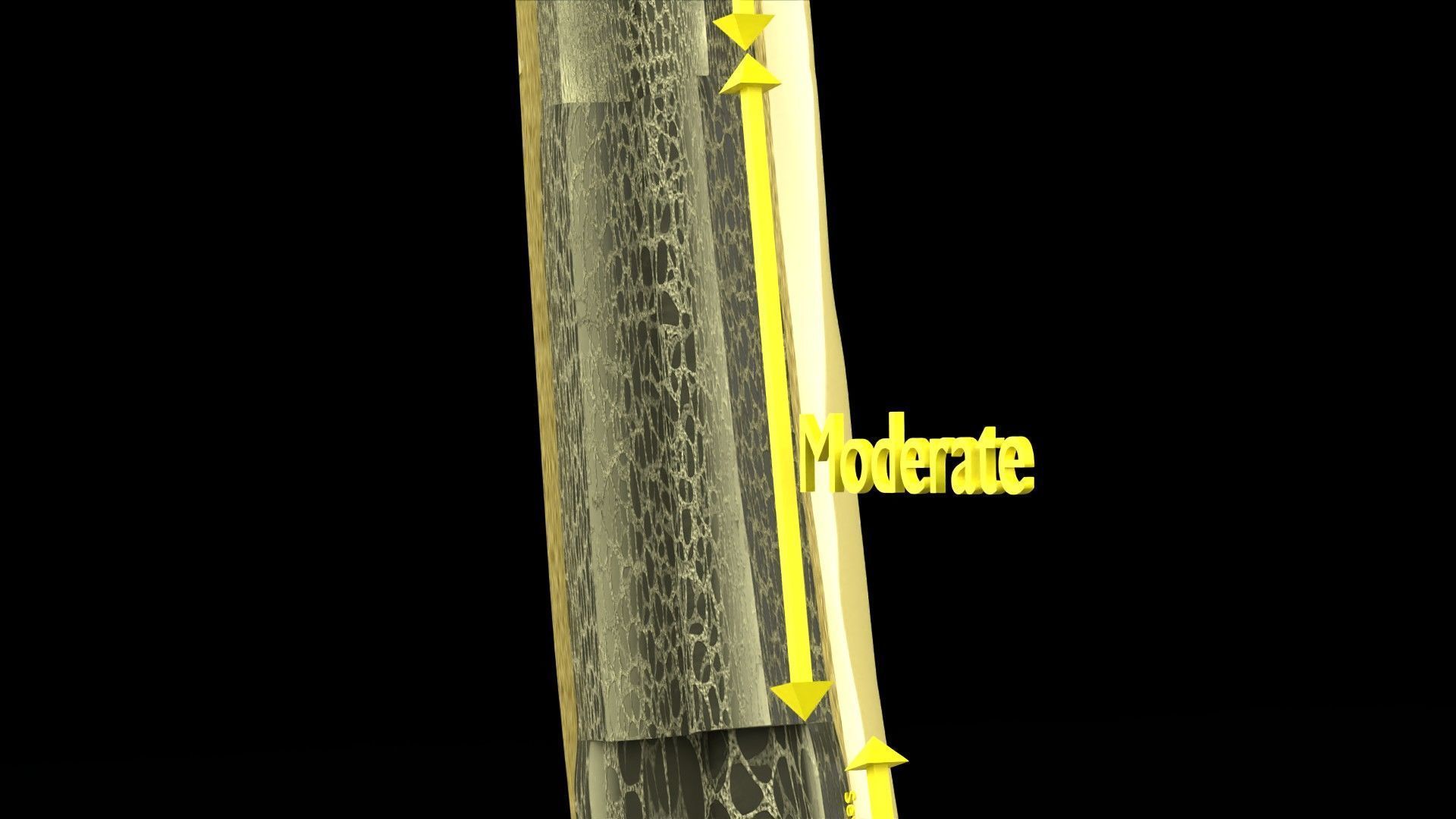 Osteoporosis and its stages Low-poly 3D model_7