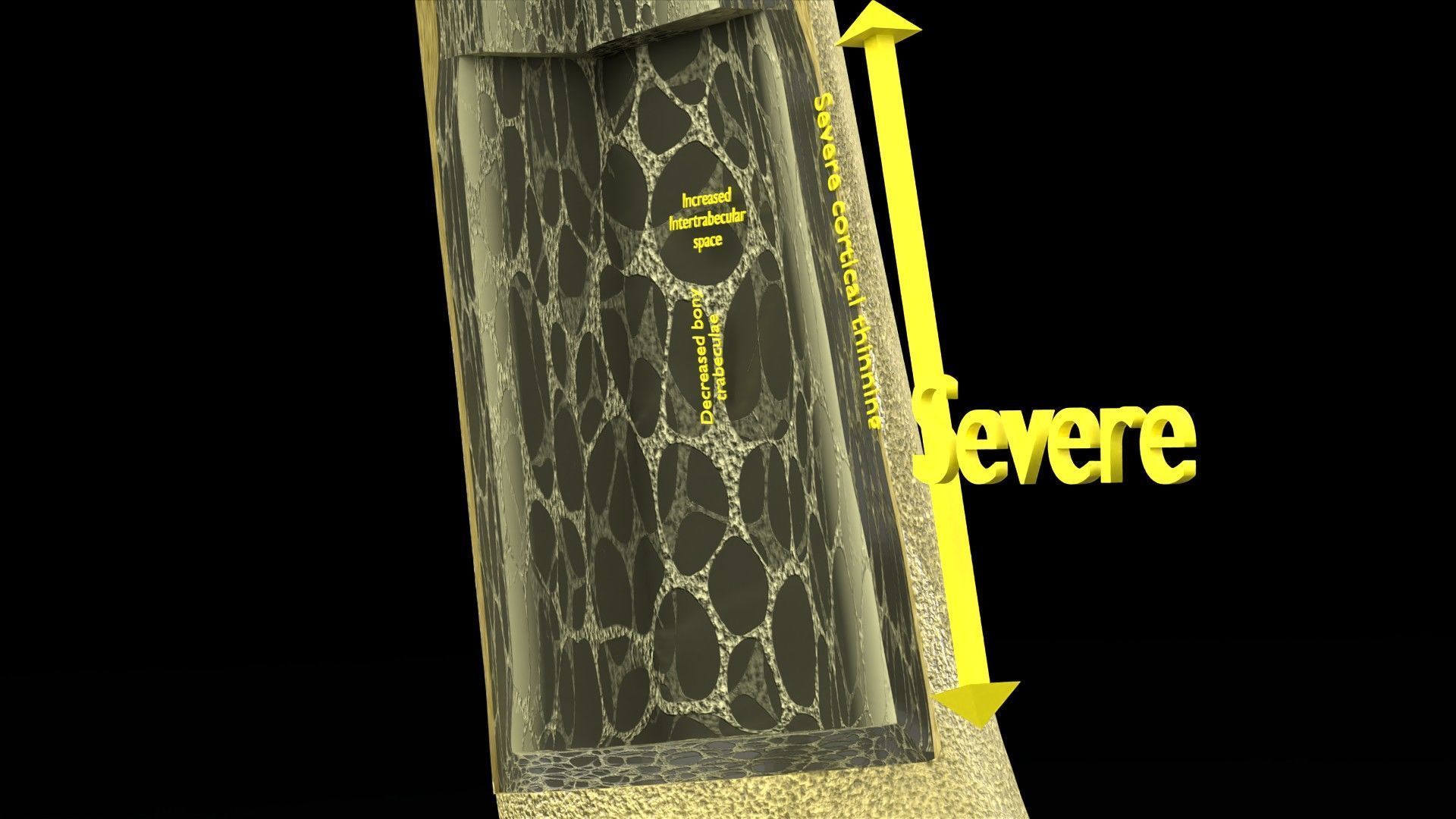 Osteoporosis and its stages Low-poly 3D model_17
