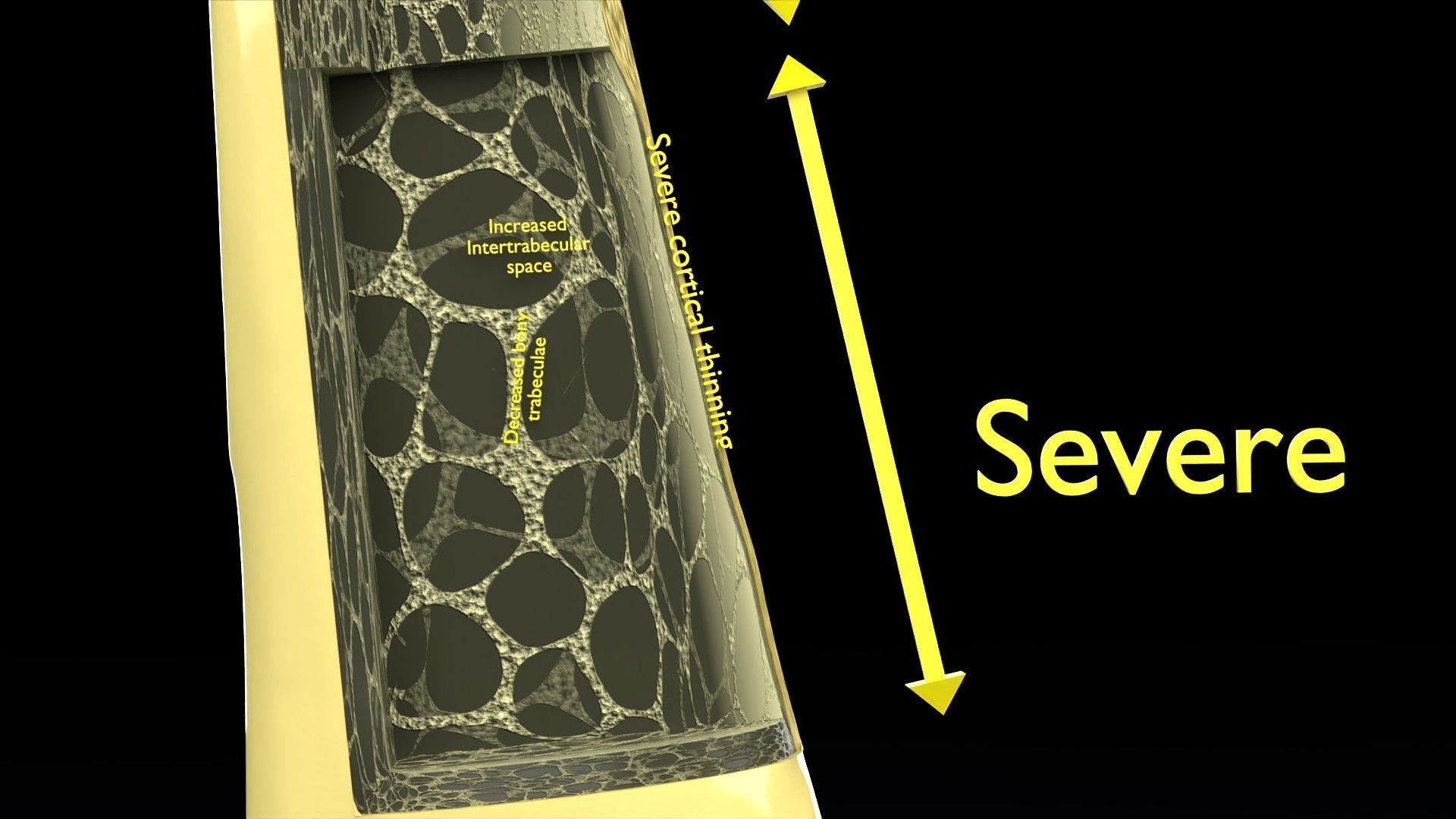 Osteoporosis and its stages Low-poly 3D model_14