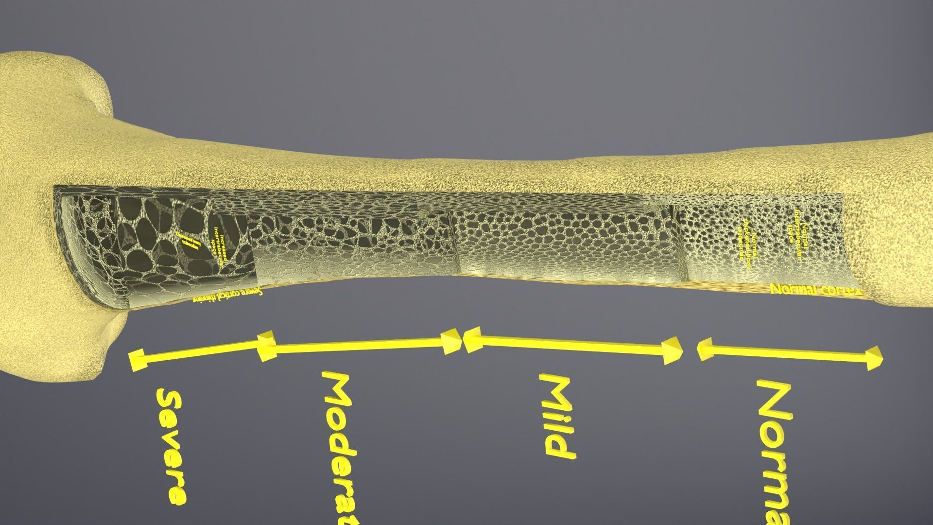 Osteoporosis and its stages Low-poly 3D model_30