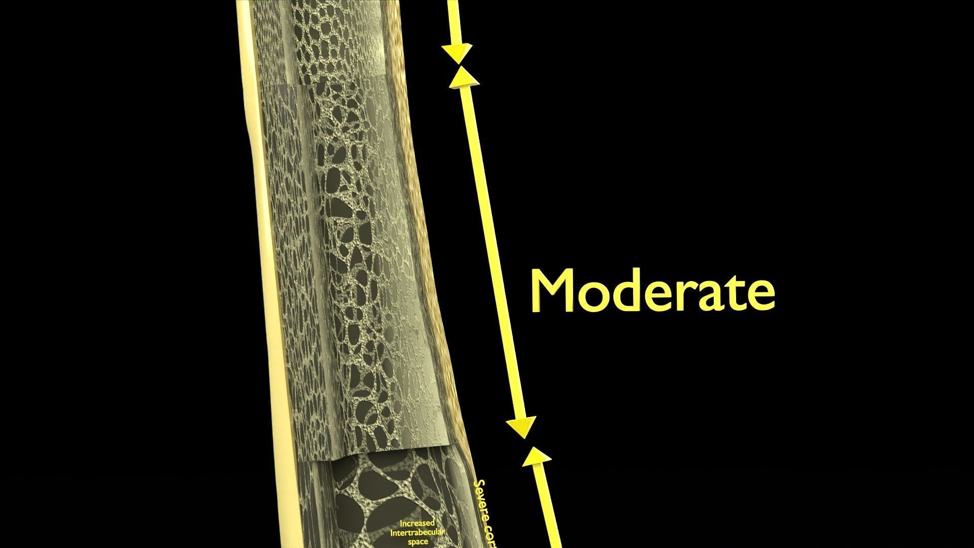 Osteoporosis and its stages Low-poly 3D model_11