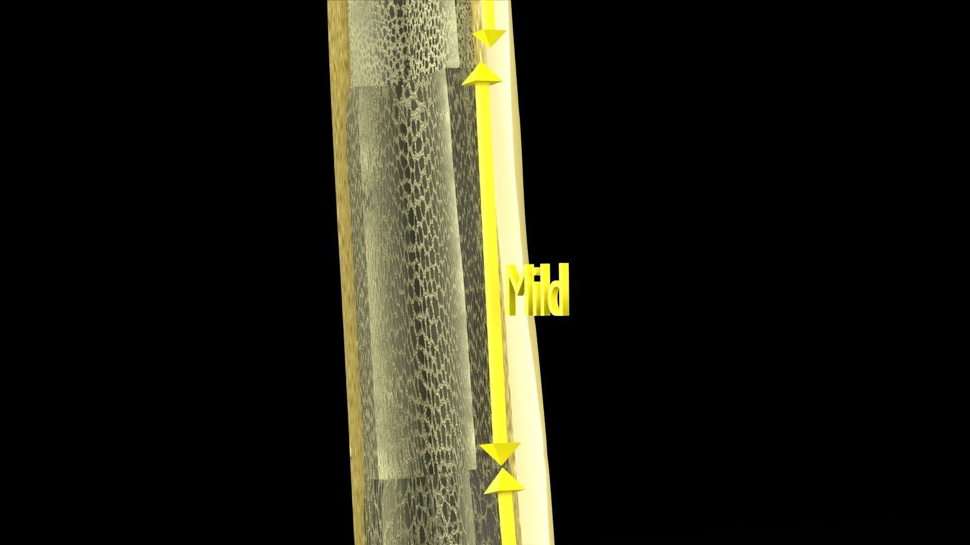 Osteoporosis and its stages Low-poly 3D model_6