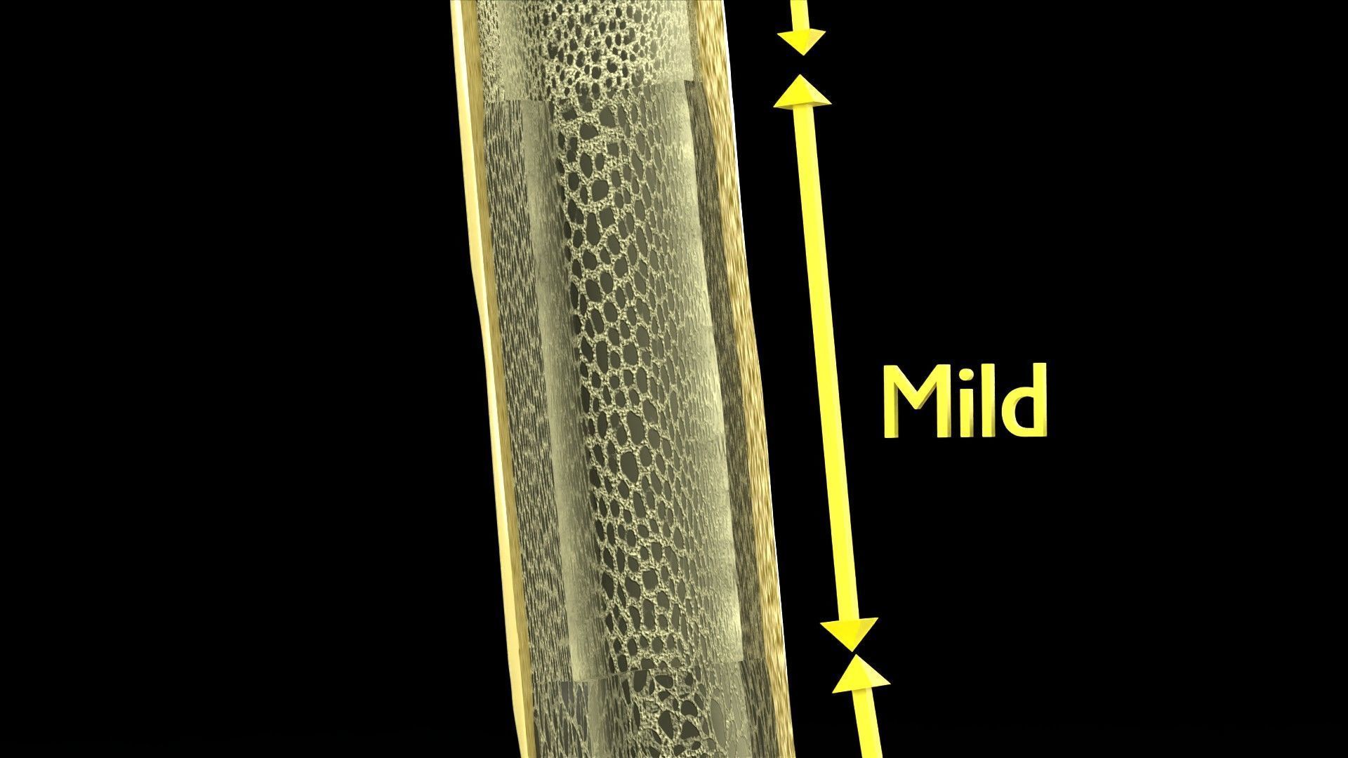 Osteoporosis and its stages Low-poly 3D model_5