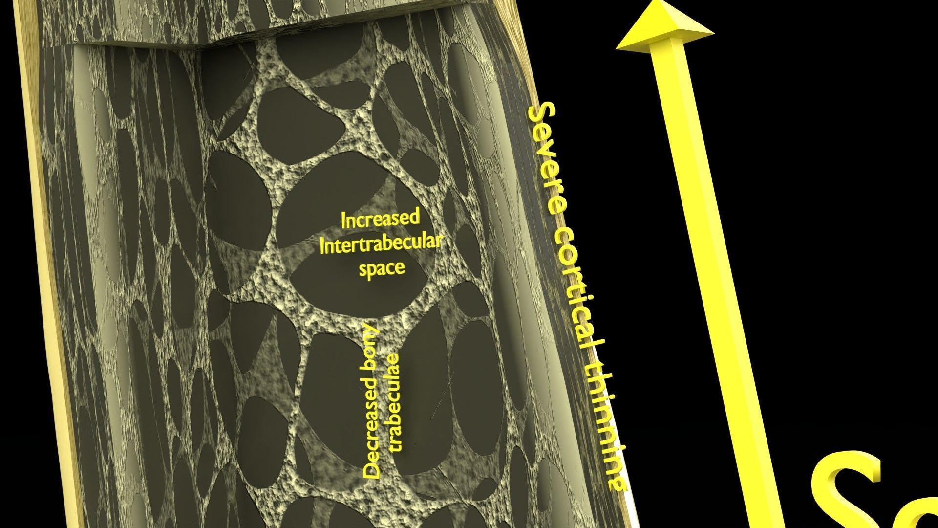 Osteoporosis and its stages Low-poly 3D model_16