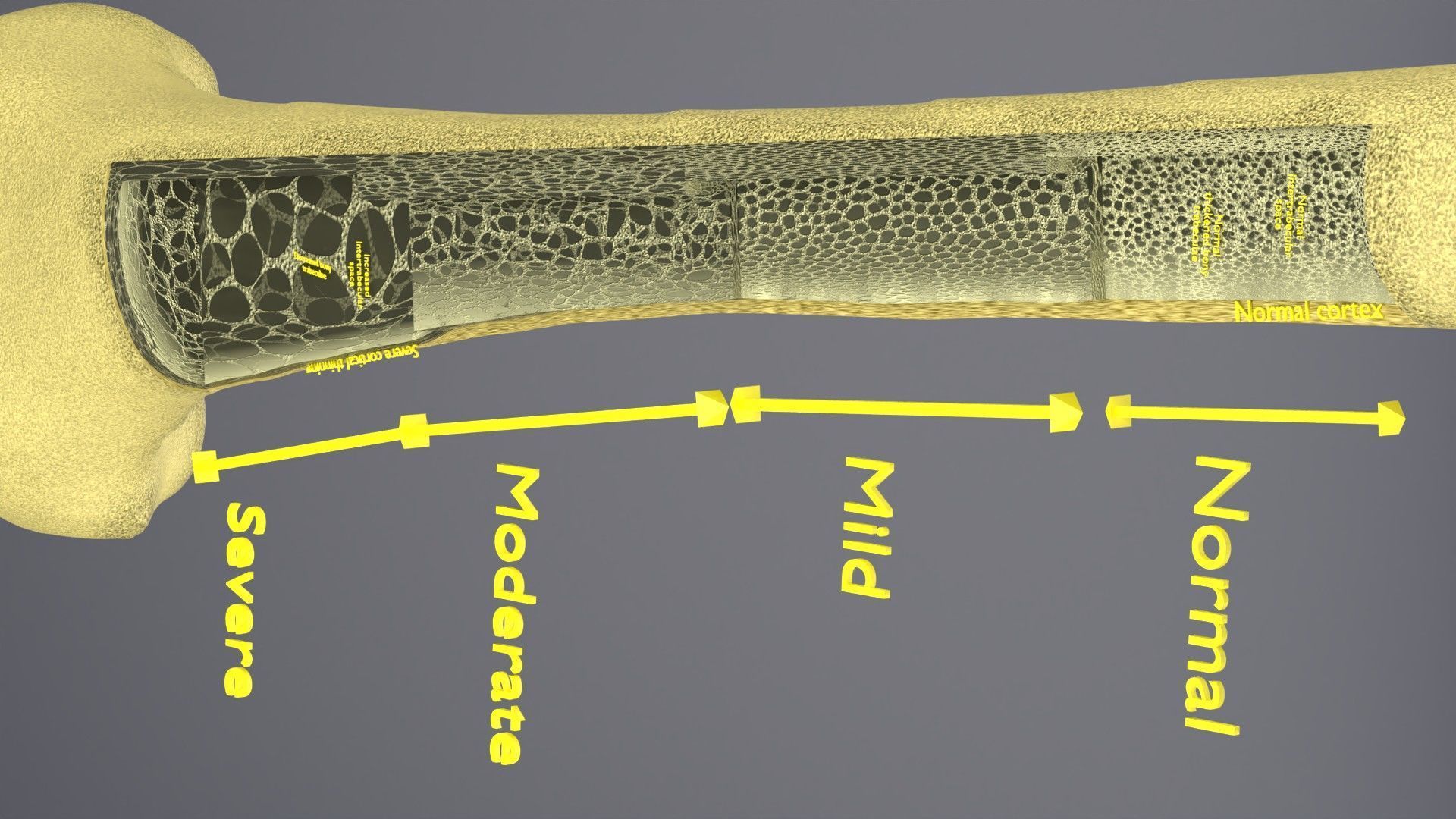 Osteoporosis and its stages Low-poly 3D model_29