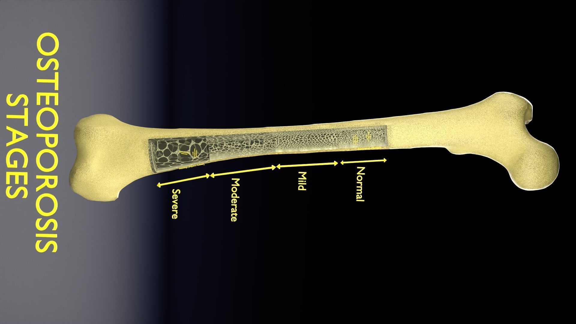 Osteoporosis and its stages Low-poly 3D model_27