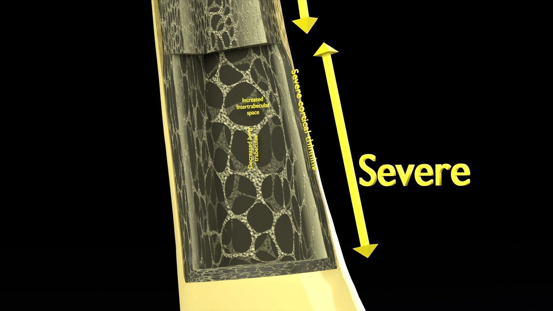 Osteoporosis and its stages Low-poly 3D model_15