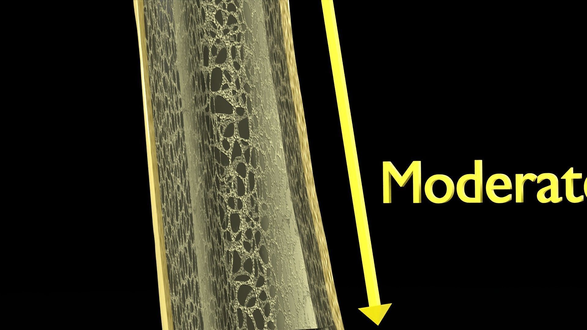 Osteoporosis and its stages Low-poly 3D model_9