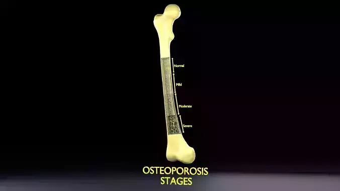 Osteoporosis and its stages Low-poly 3D model