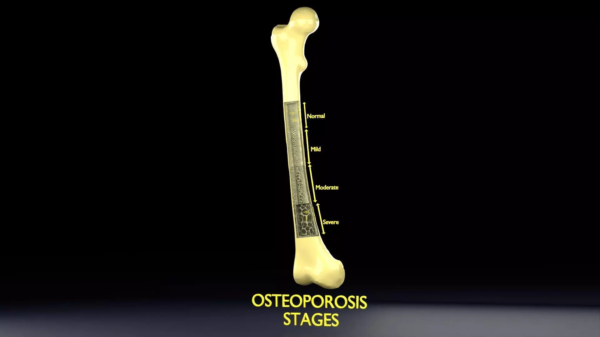 Osteoporosis and its stages Low-poly 3D model_0