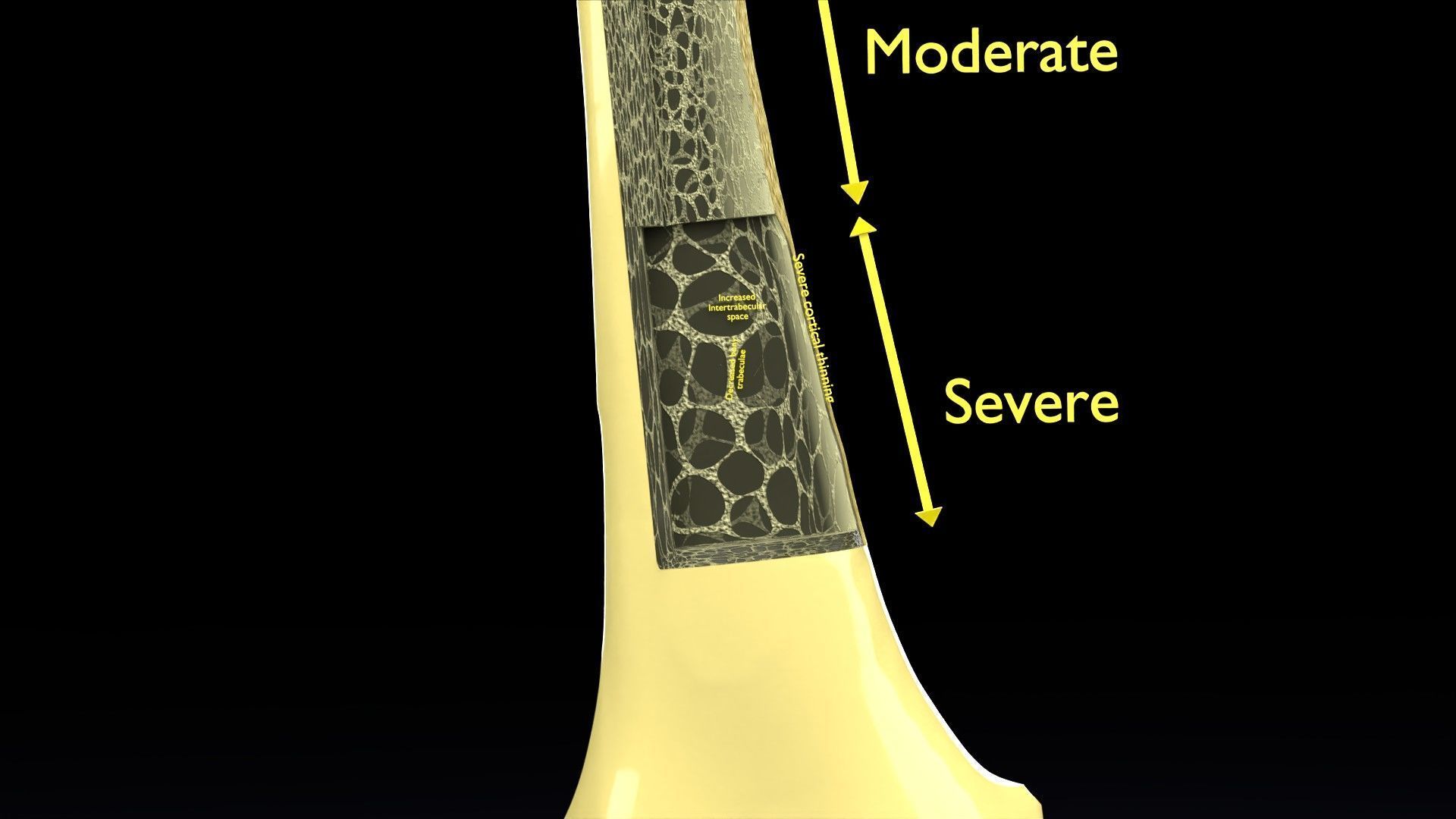 Osteoporosis and its stages Low-poly 3D model_13