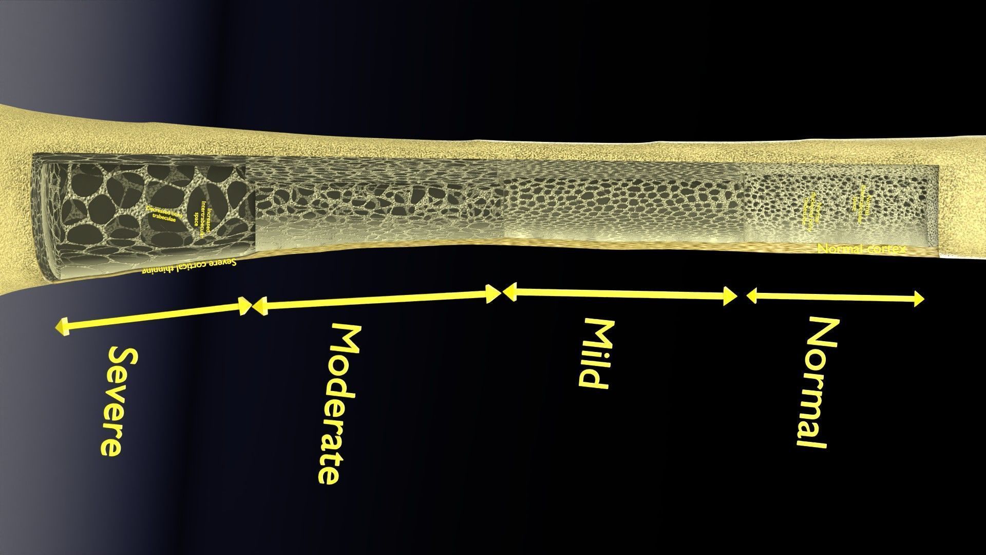 Osteoporosis and its stages Low-poly 3D model_28
