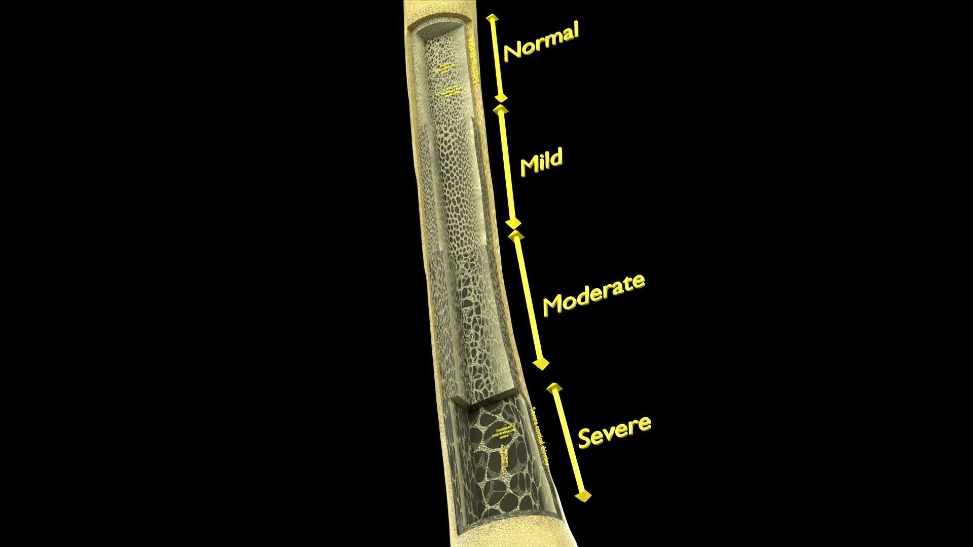Osteoporosis and its stages Low-poly 3D model_22