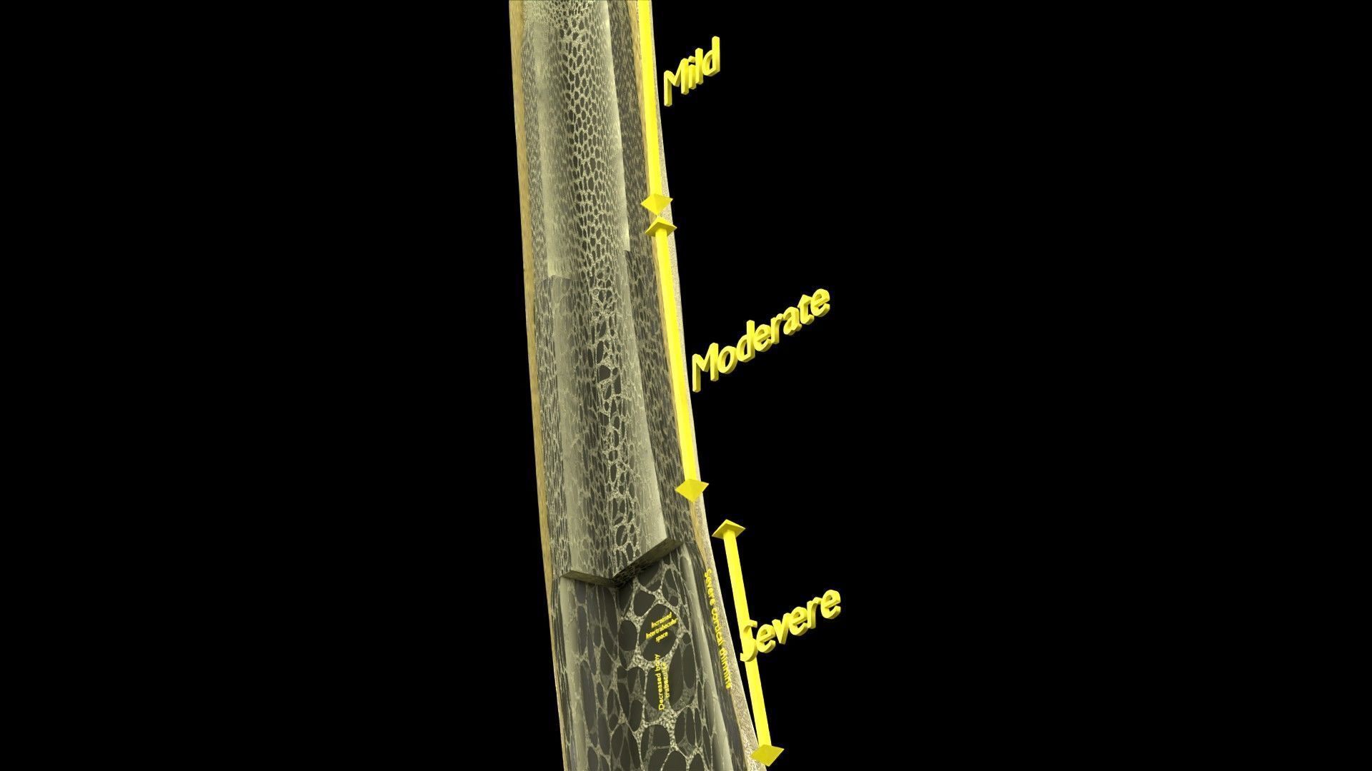 Osteoporosis and its stages Low-poly 3D model_18