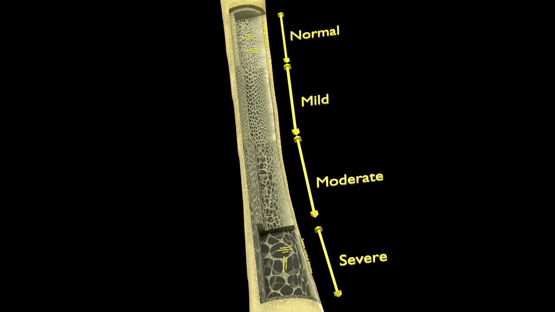 Osteoporosis and its stages Low-poly 3D model_25