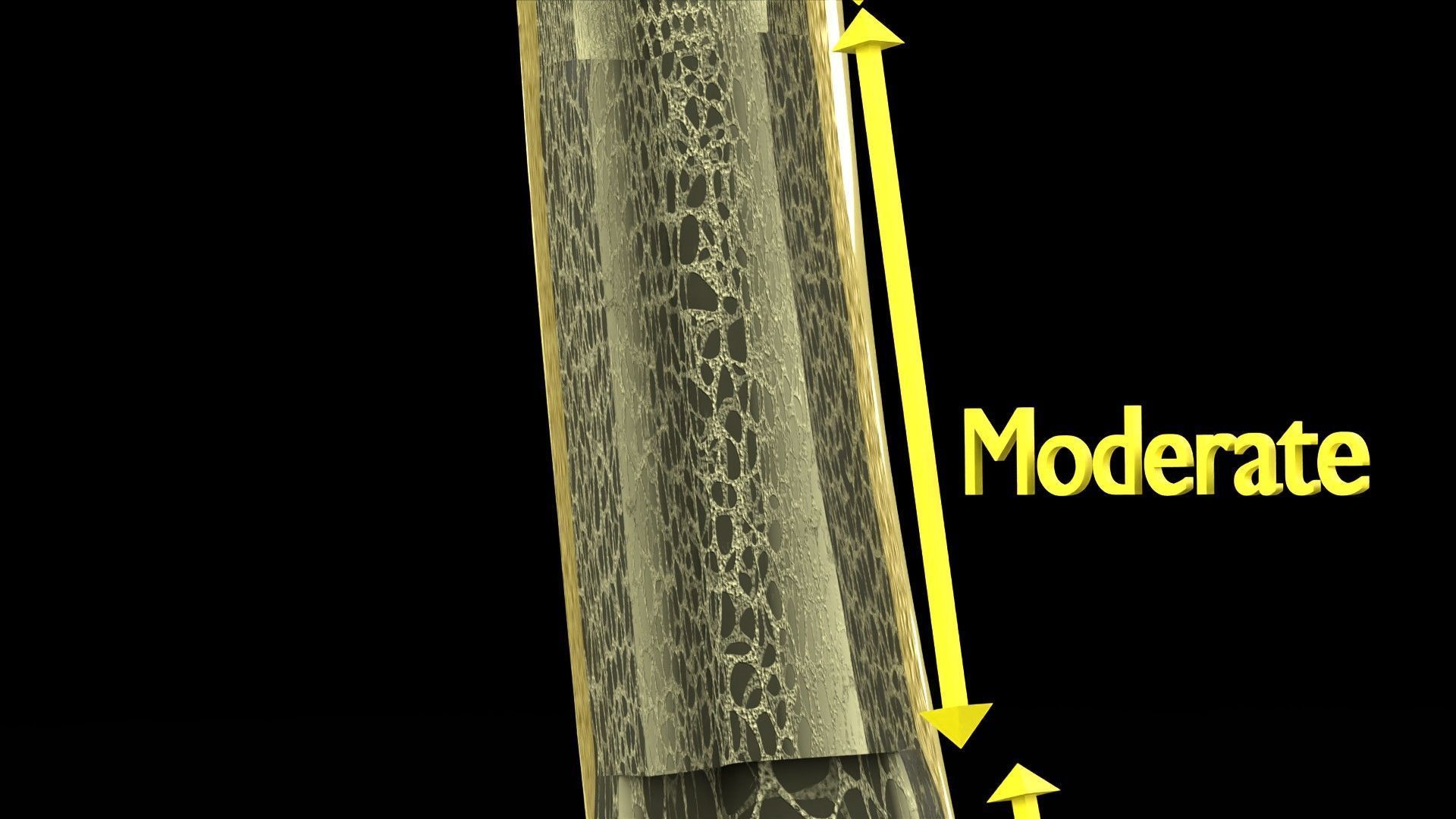 Osteoporosis and its stages Low-poly 3D model_8