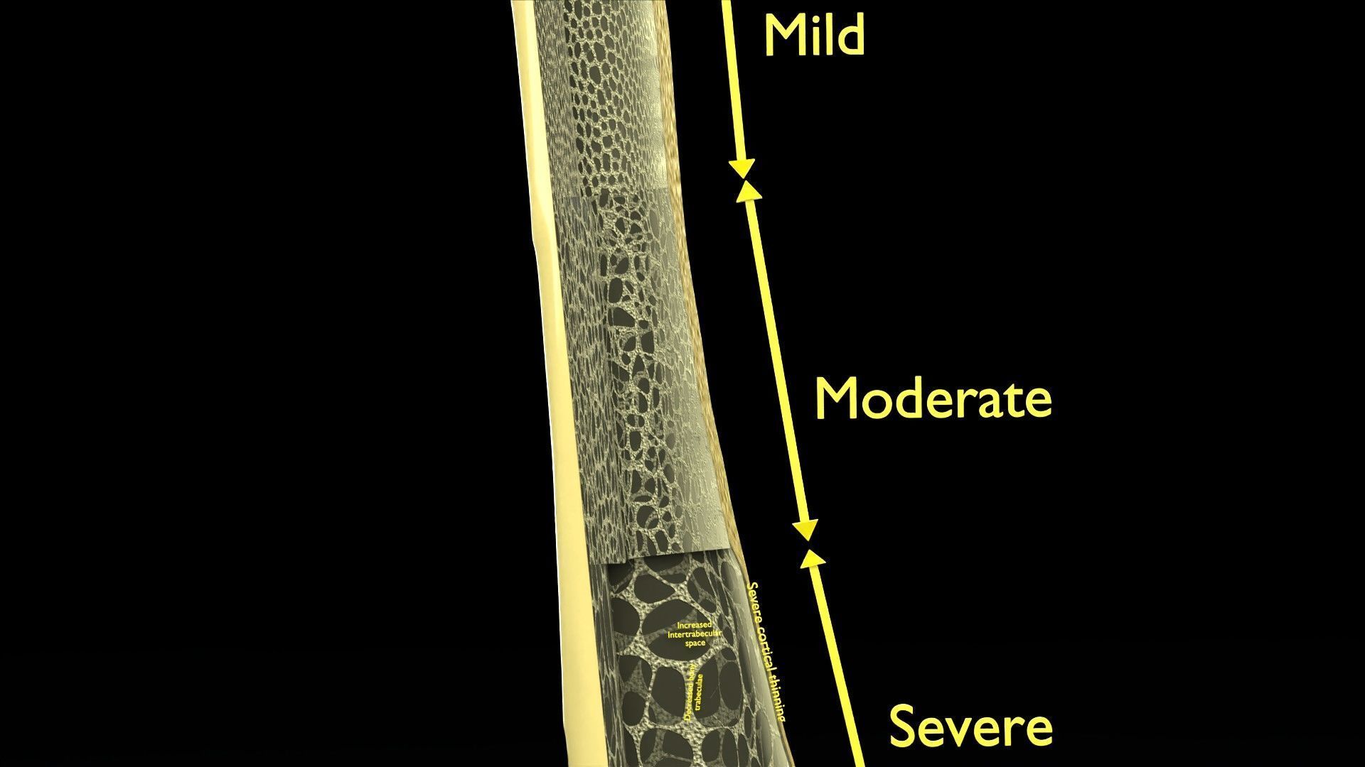 Osteoporosis and its stages Low-poly 3D model_12