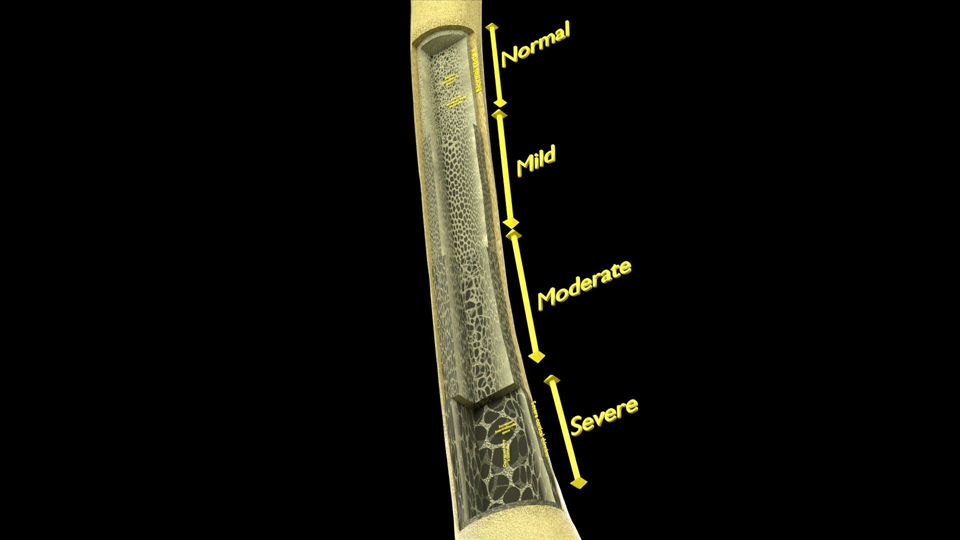 Osteoporosis and its stages Low-poly 3D model_21