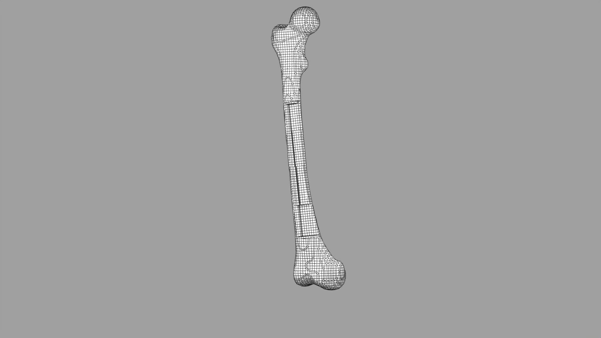 Osteoporosis and its stages Low-poly 3D model_36