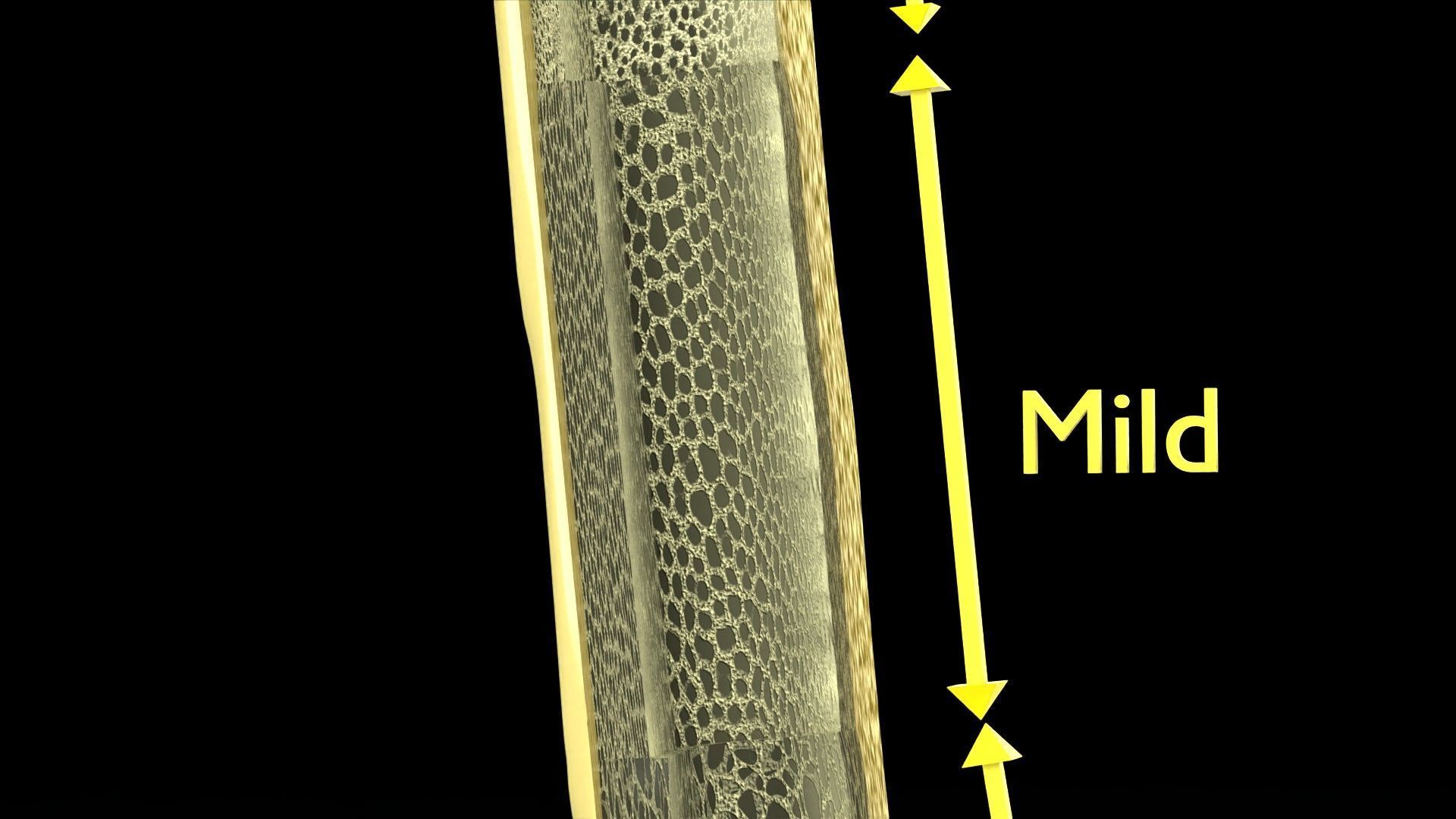 Osteoporosis and its stages Low-poly 3D model_4