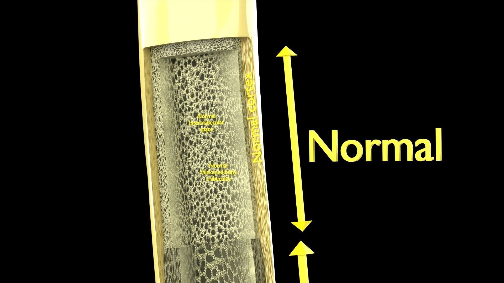 Osteoporosis and its stages Low-poly 3D model_2