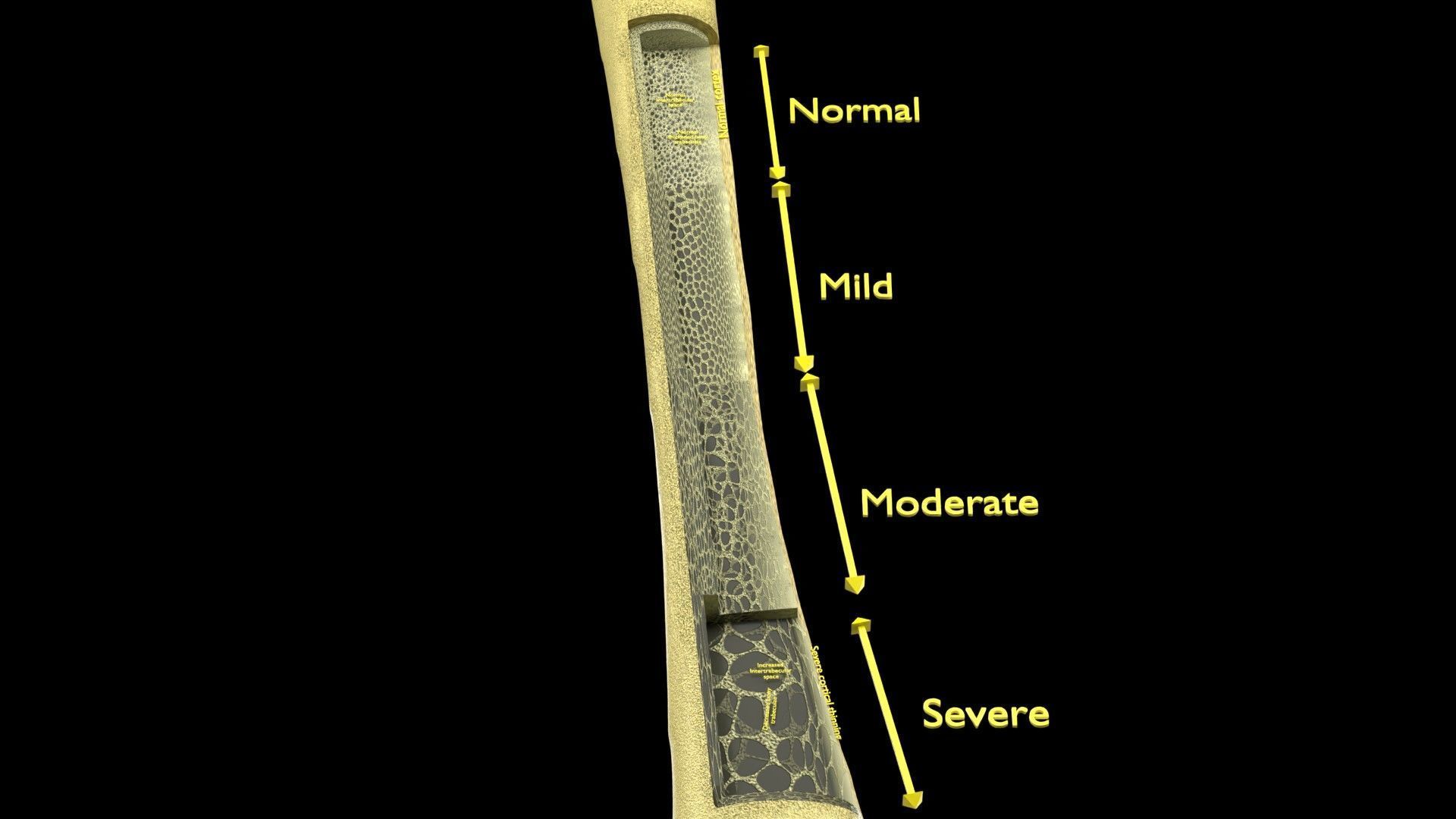 Osteoporosis and its stages Low-poly 3D model_26