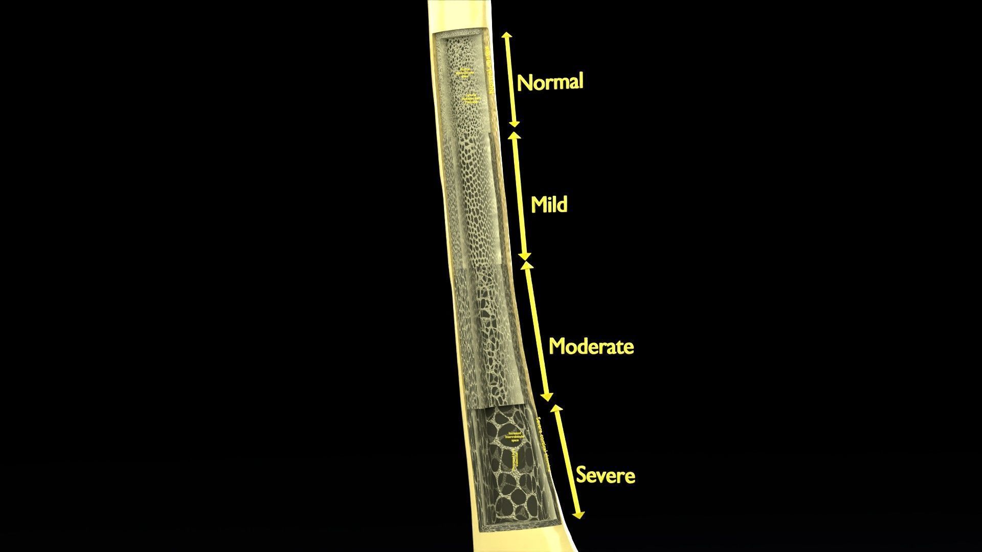 Osteoporosis and its stages Low-poly 3D model_1