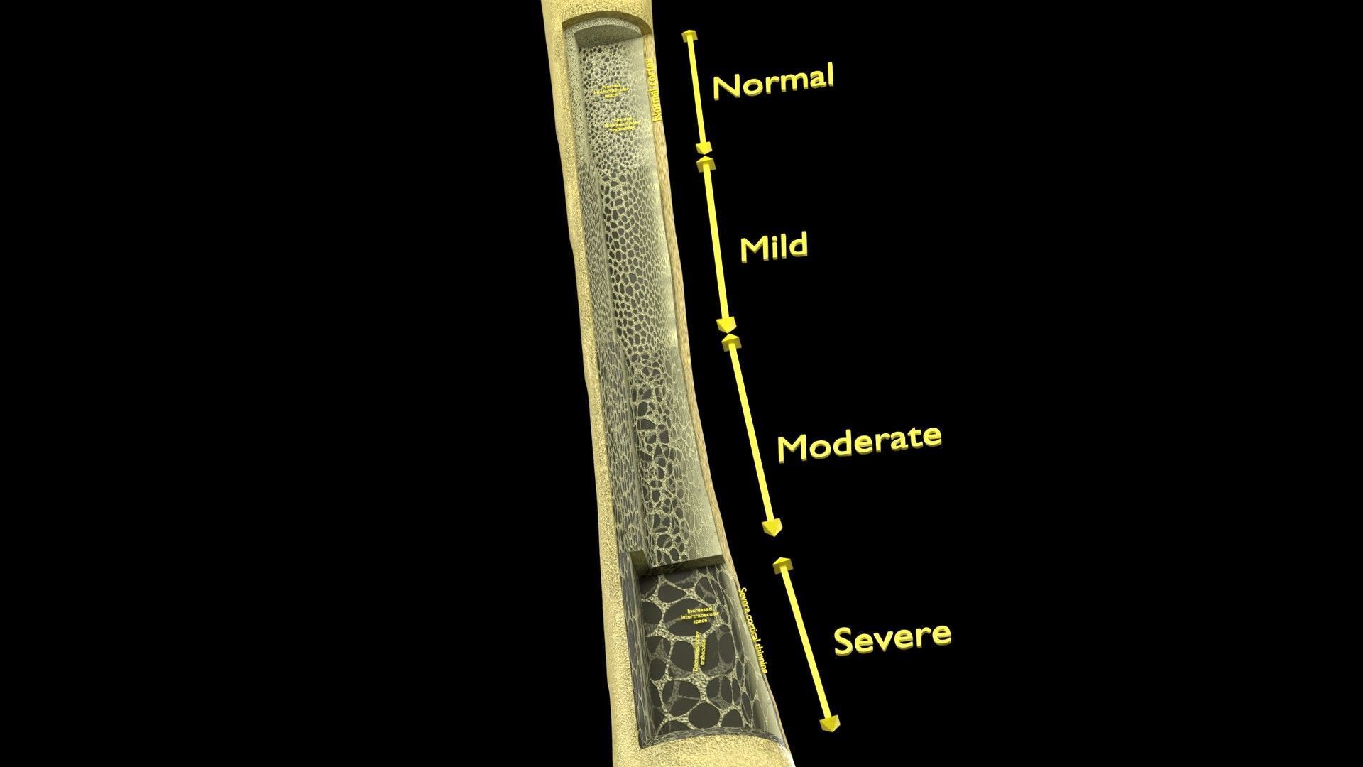 Osteoporosis and its stages Low-poly 3D model_24