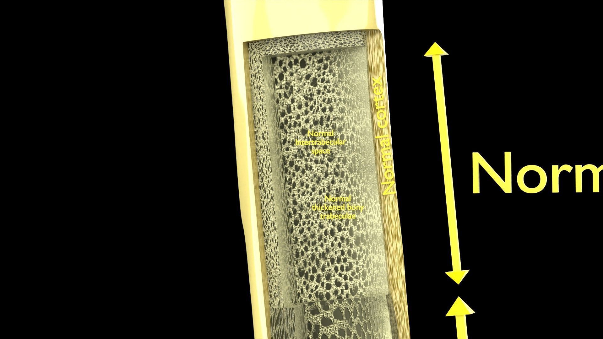 Osteoporosis and its stages Low-poly 3D model_3