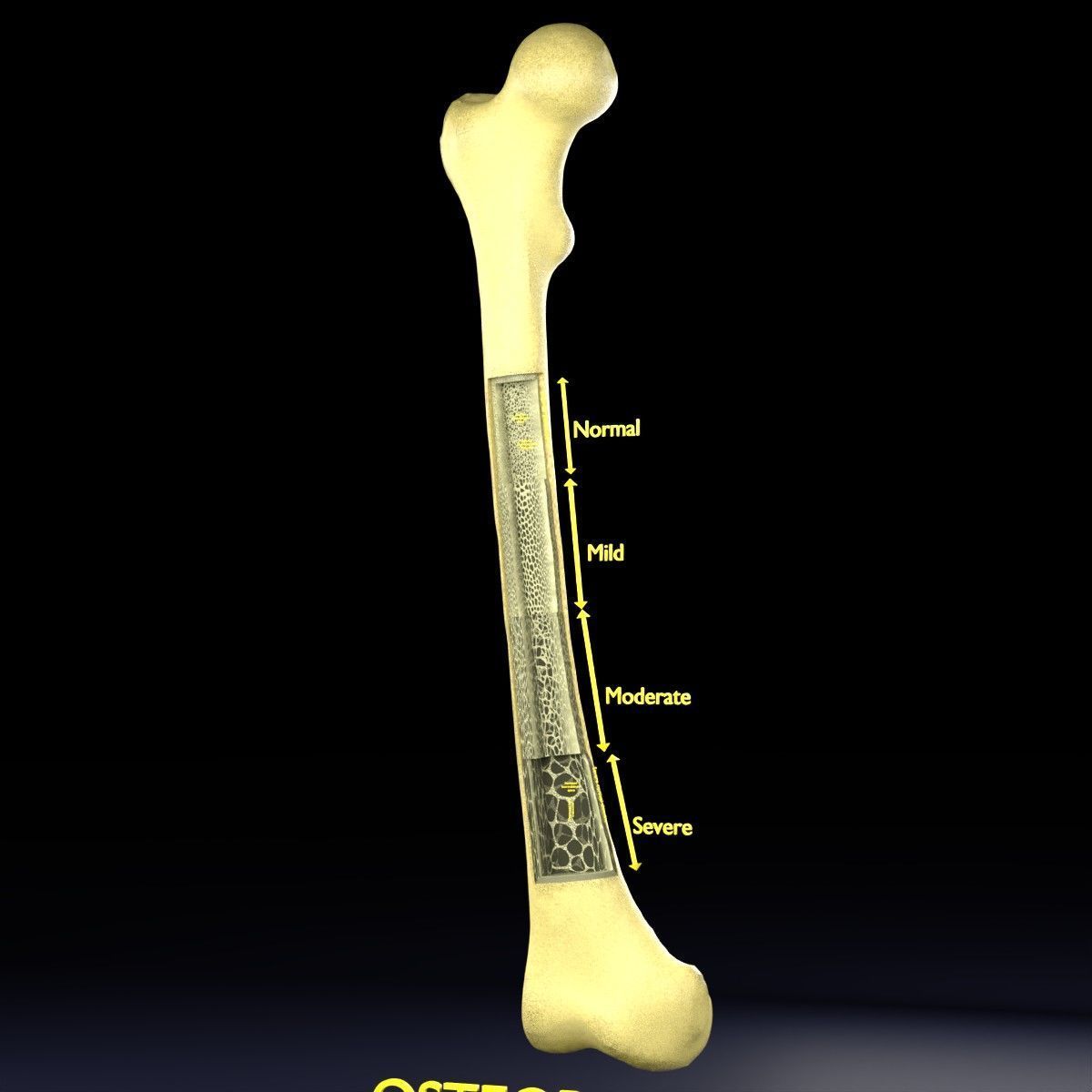 Osteoporosis and its stages Low-poly 3D model_33