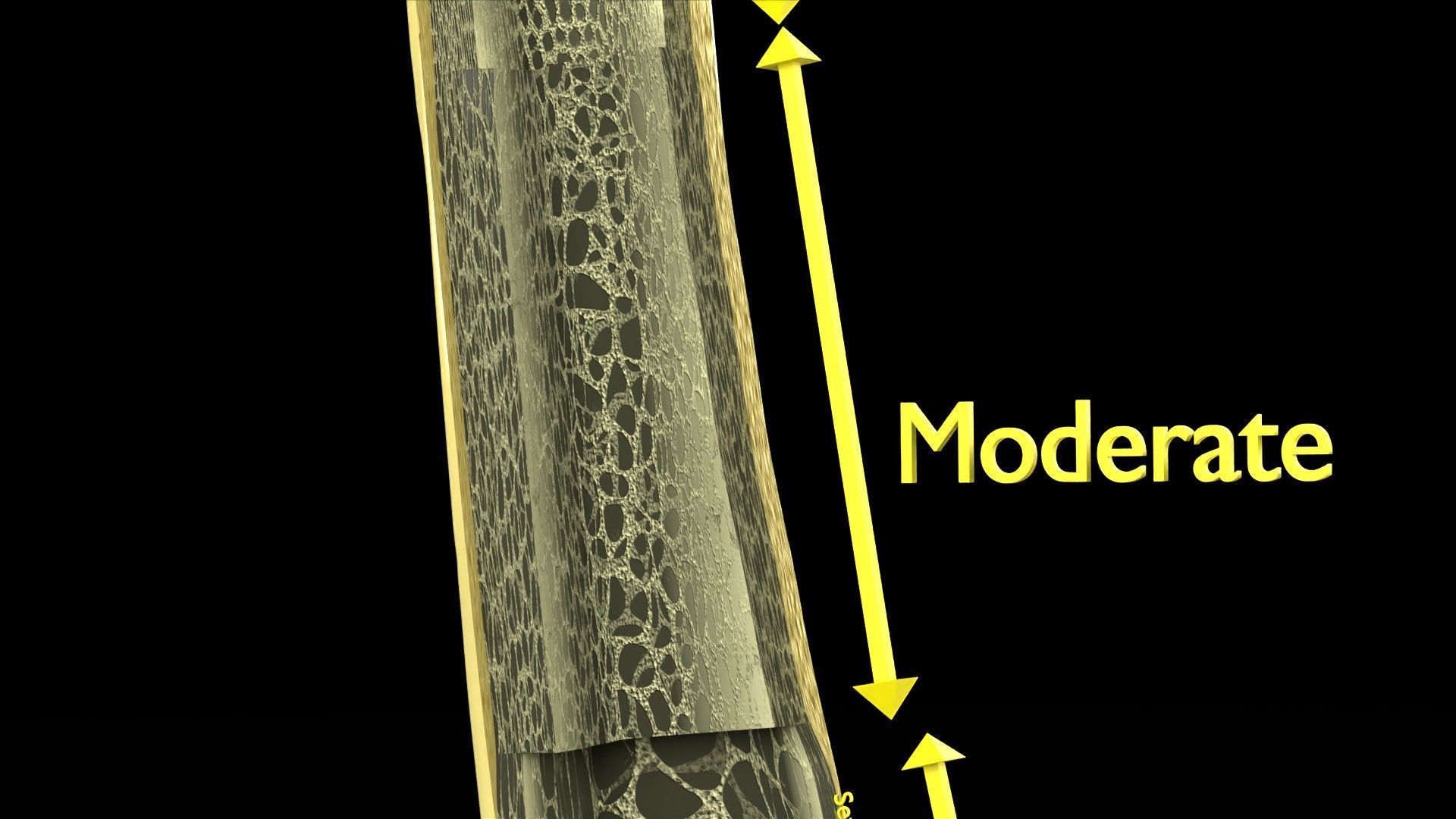Osteoporosis and its stages Low-poly 3D model_10