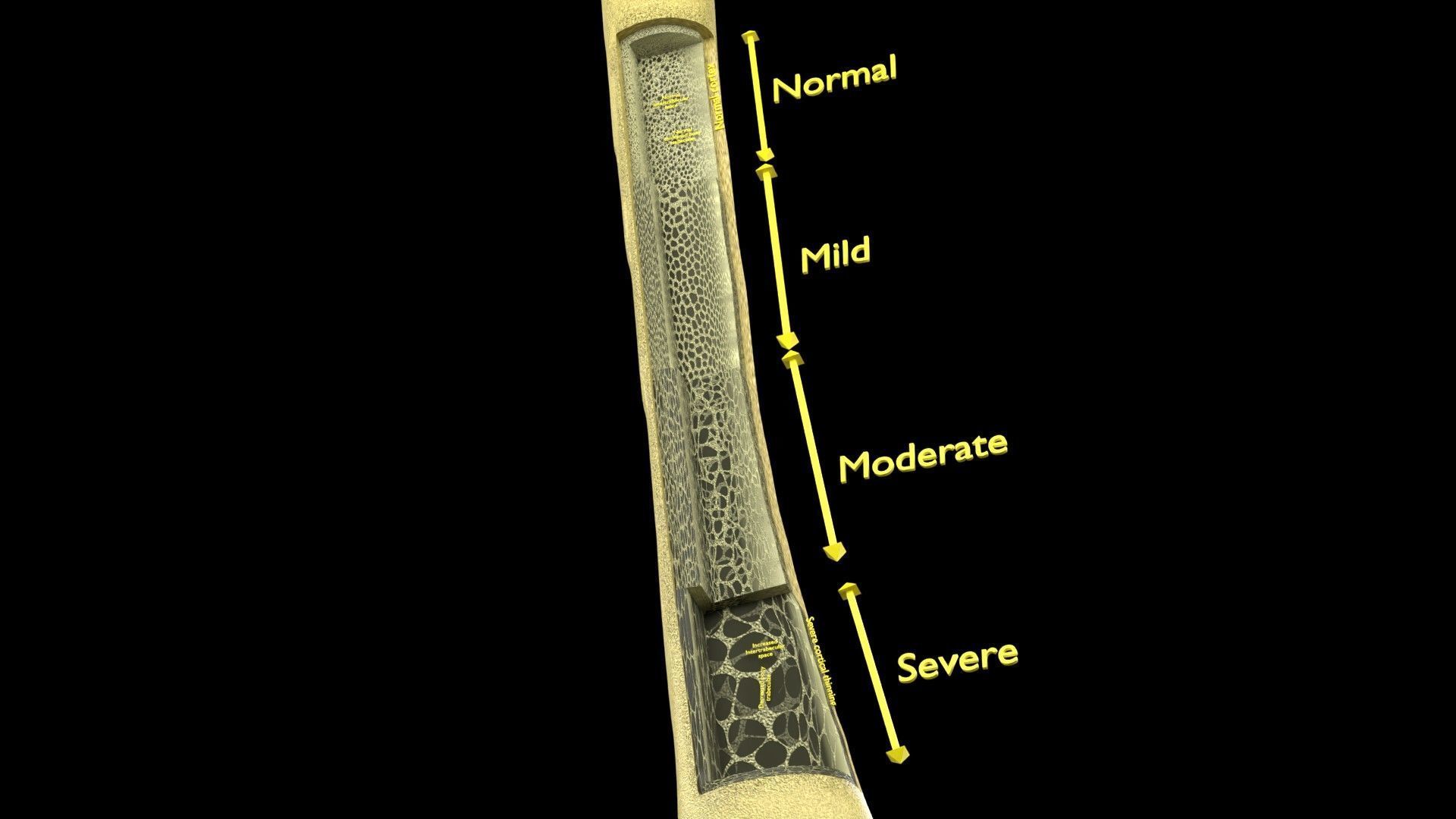 Osteoporosis and its stages Low-poly 3D model_23