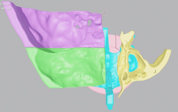 Multiple Parts 3D Printable Nasal Sinus Based on Real CT scan 3D print model_6