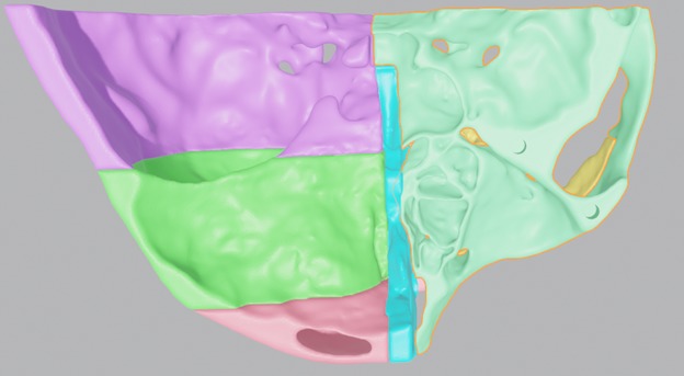 Multiple Parts 3D Printable Nasal Sinus Based on Real CT scan 3D print model_3
