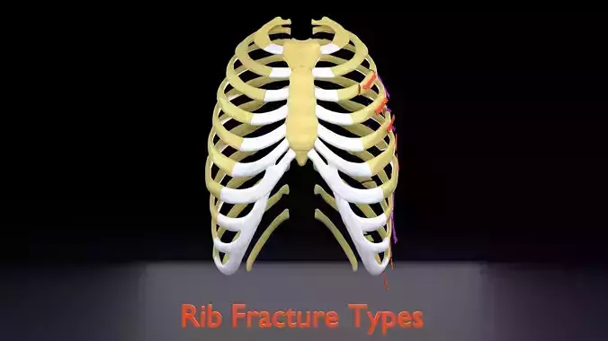 Rib fracture and its types
