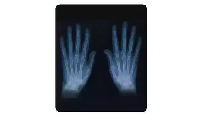 Hand Xray