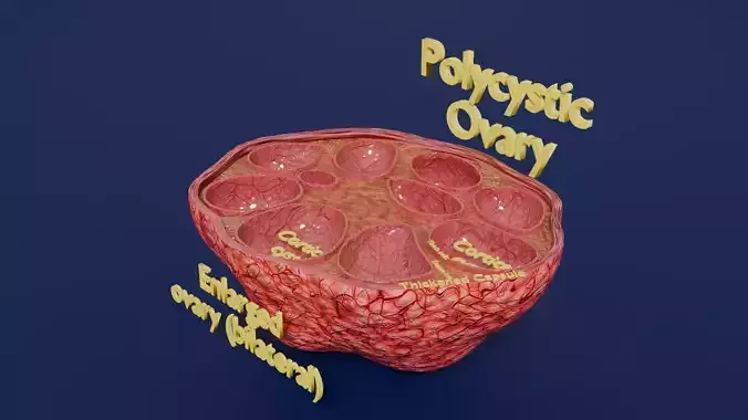 Polycystic Ovary Disease PCOD