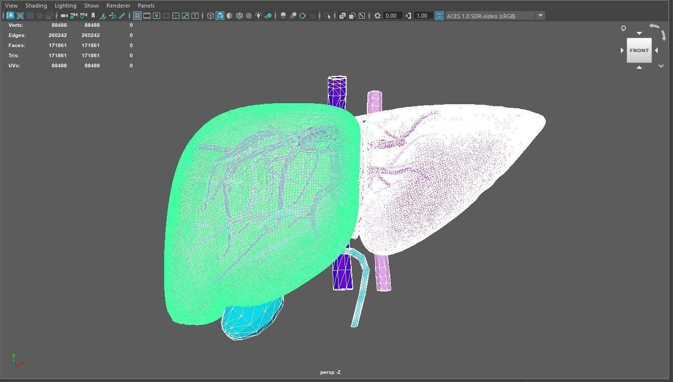 3D Model of Liver with Steatosis 3D model_4