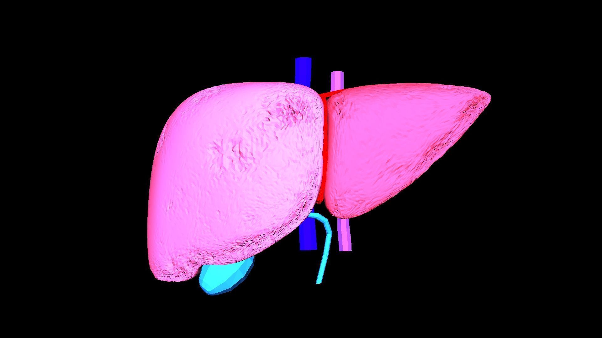3D Model of Liver with Steatosis 3D model_6