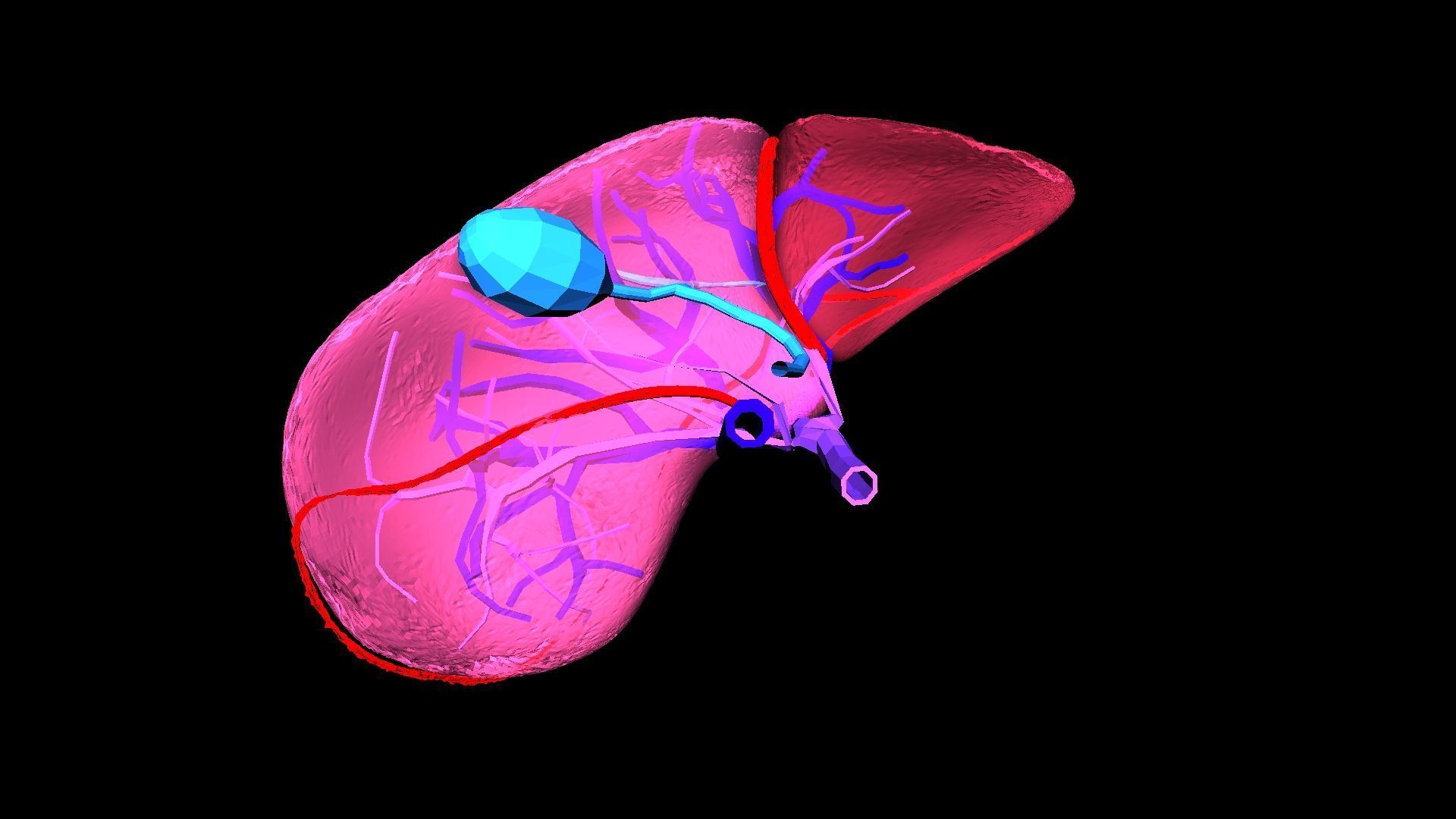 3D Model of Liver with Steatosis 3D model_14