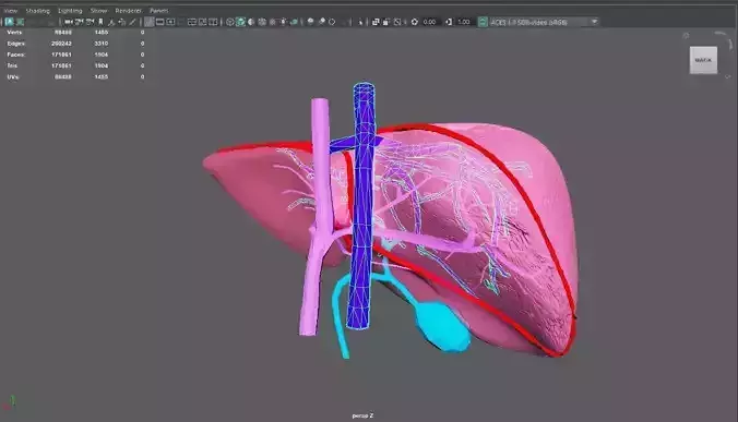 3D Model of Liver with Steatosis 3D model