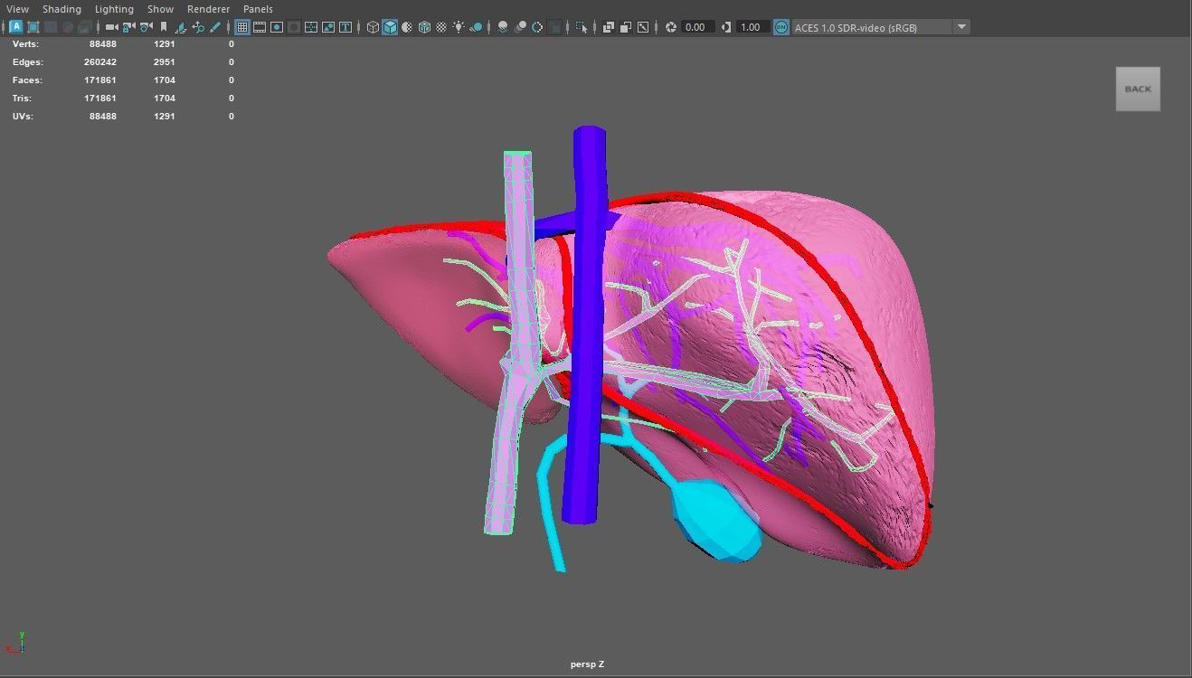 3D Model of Liver with Steatosis 3D model_1