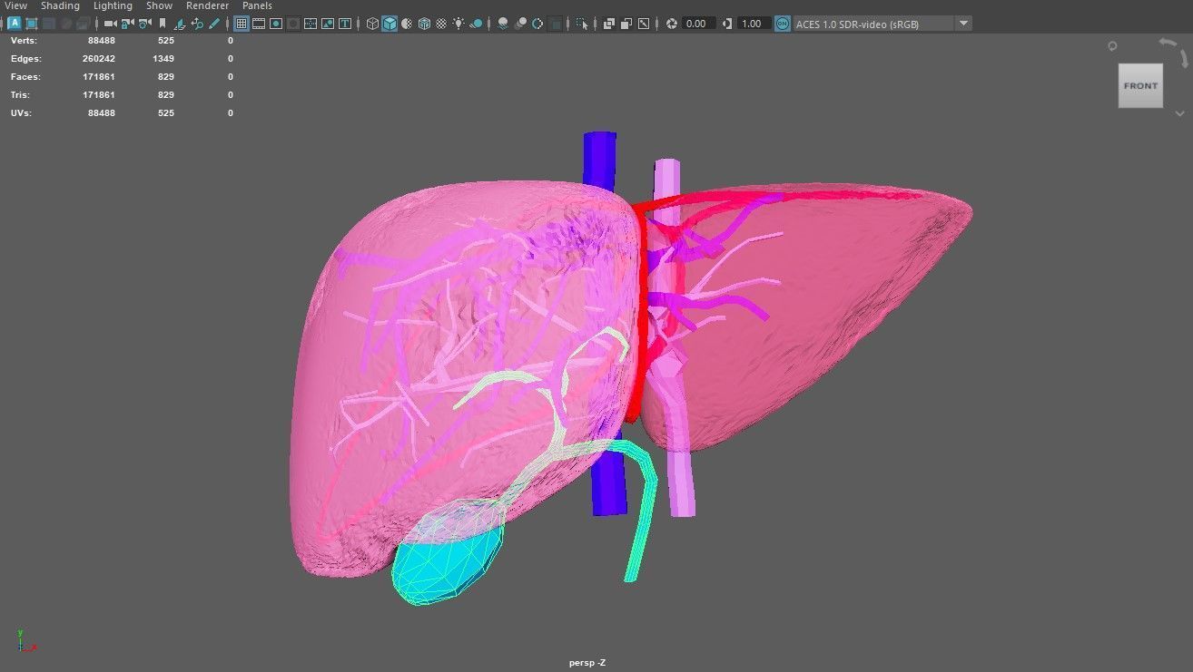 3D Model of Liver with Steatosis 3D model_5