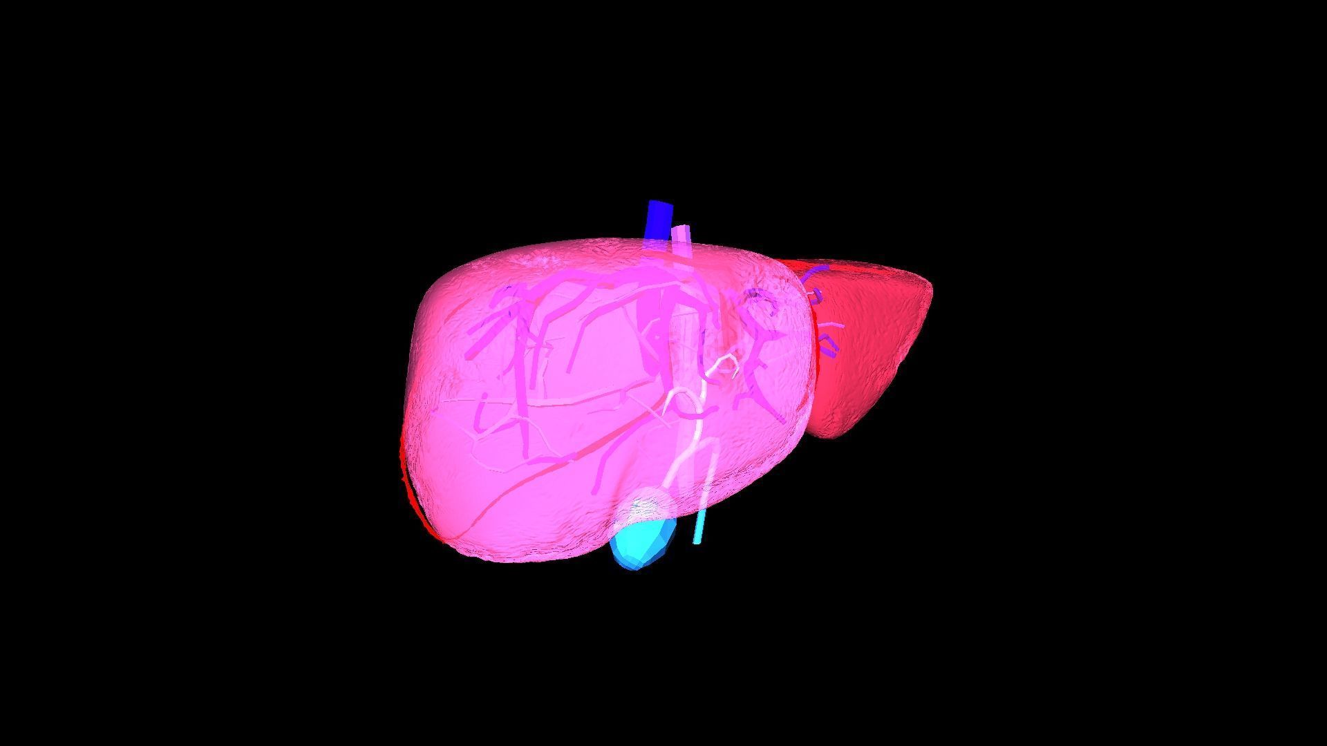 3D Model of Liver with Steatosis 3D model_7