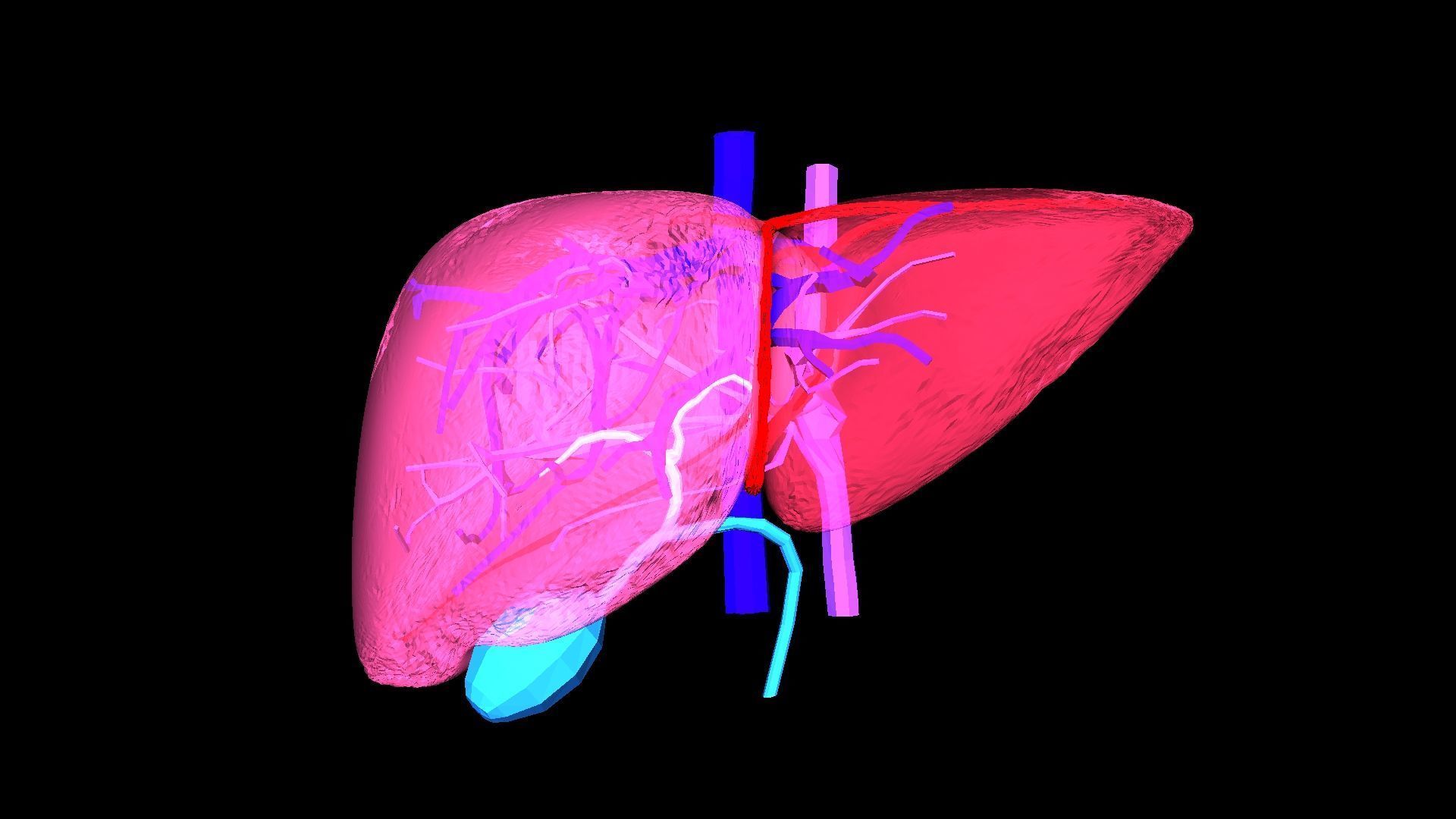 3D Model of Liver with Steatosis 3D model_15
