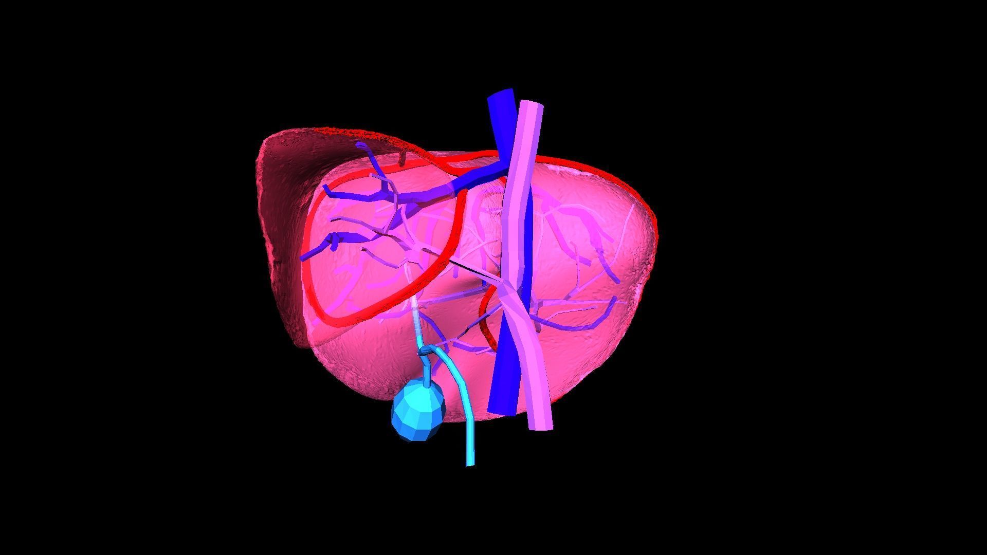 3D Model of Liver with Steatosis 3D model_12