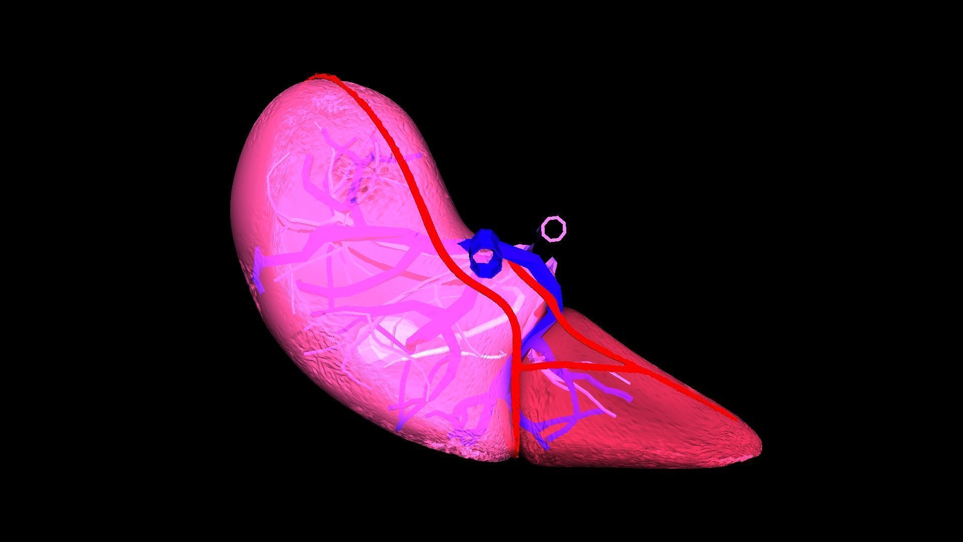 3D Model of Liver with Steatosis 3D model_13