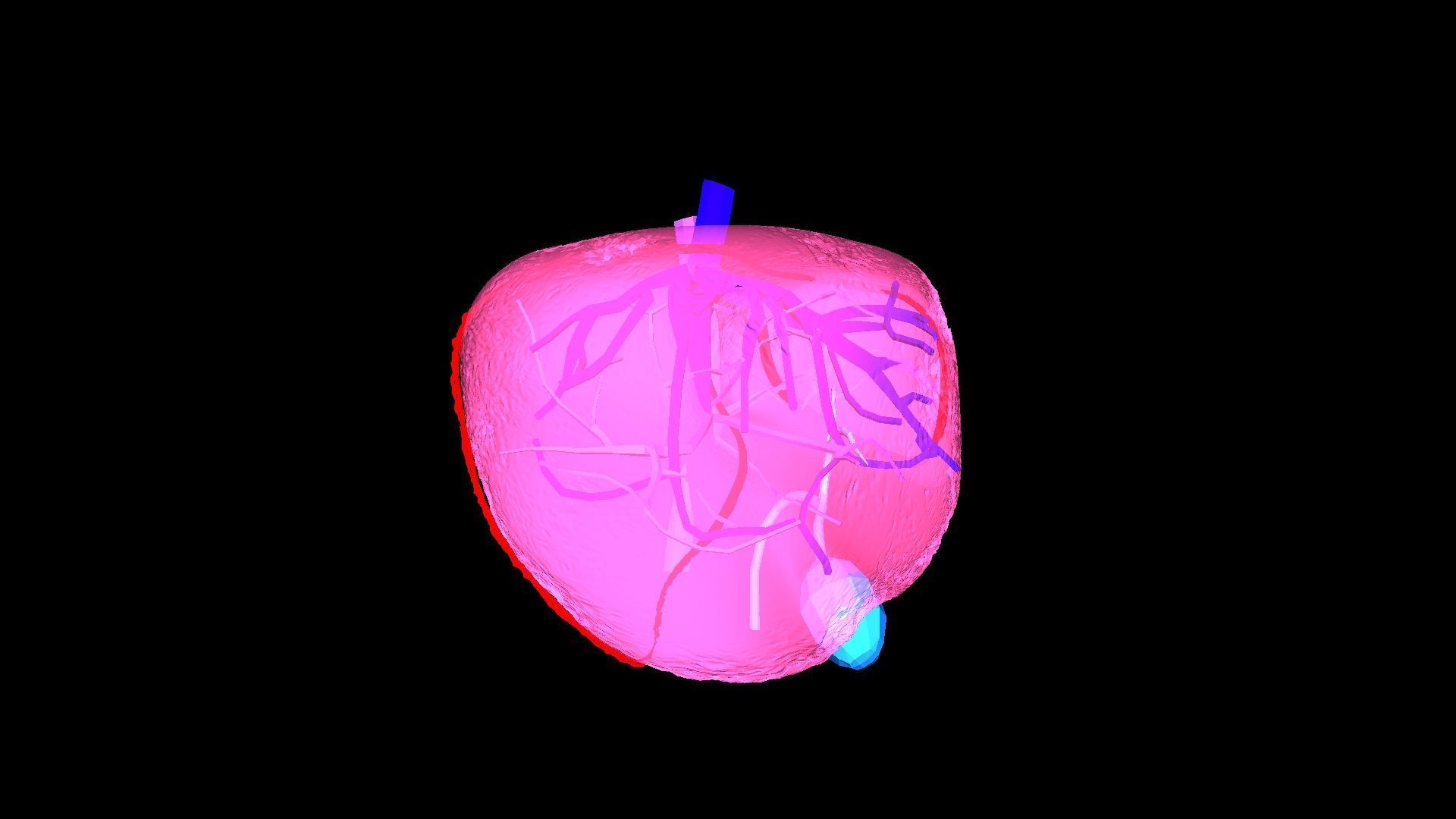 3D Model of Liver with Steatosis 3D model_8