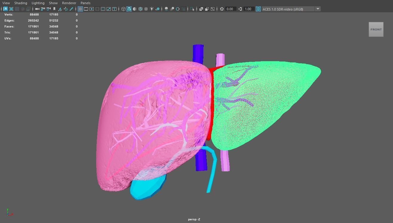 3D Model of Liver with Steatosis 3D model_3